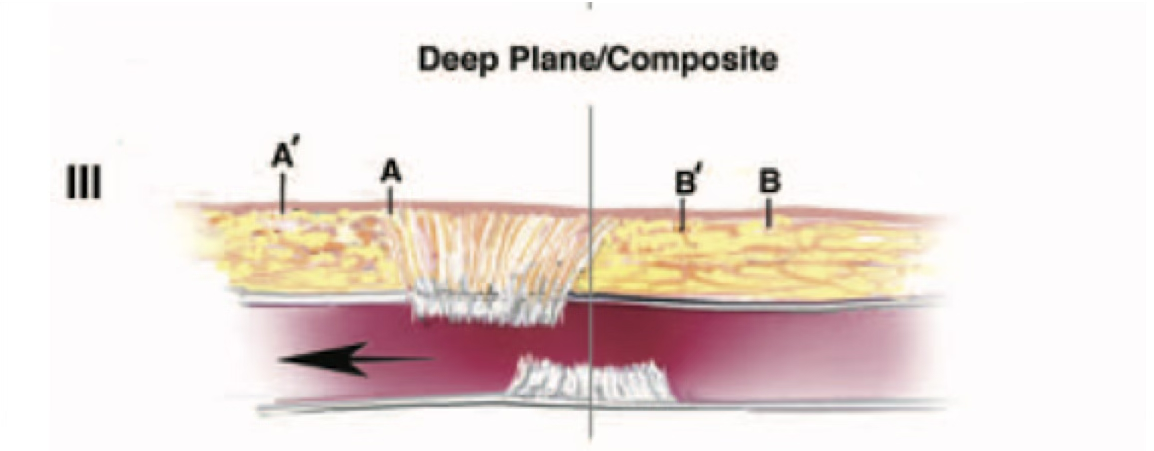 SMASの深層を剥離し複合組織として移動するDeep Plane・Composite Faceliftの模式図